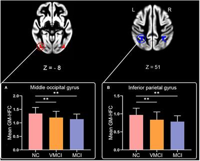 Altered Homotopic Functional Connectivity Within White Matter in the Early Stages of Alzheimer’s Disease